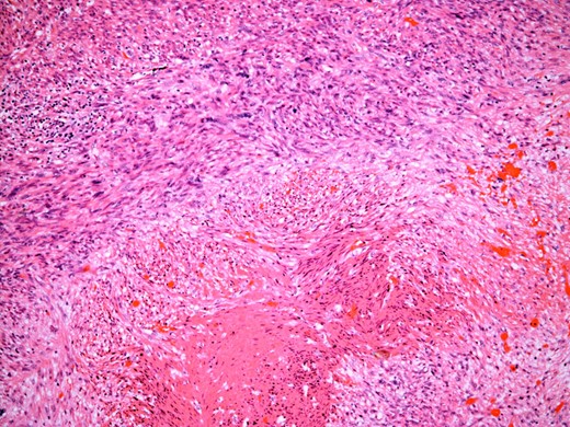 The tumour comprises fascicles of atypical spindle cells showing prominent cytological atypia and nuclear pleomorphism. Zones of coagulative tumour cell necrosis are present.
