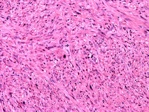 On higher power, severe cytological atypia is evident, with frequent mitotic figures including atypical mitotic forms.