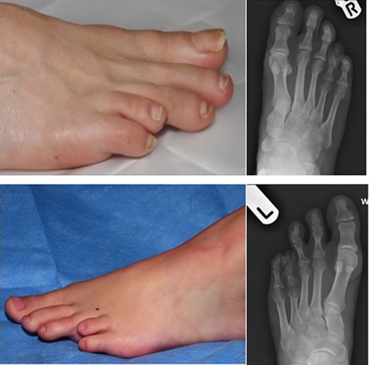 Pre-operative images on the left alongside x-rays on the right depicting congenitally short fourth toes.