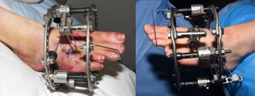 Circular external fixators showing application method.