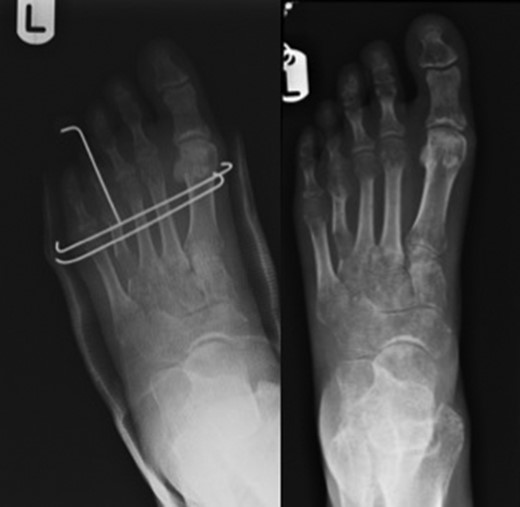Figure on the left showing trans-metatarsal K-wires in-situ along with the toe carrying wire cut and left alone. Figure on the right showing callus formation over distraction zone.