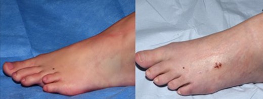 Pre-operative image on the left with image on the right showing successful lengthening.