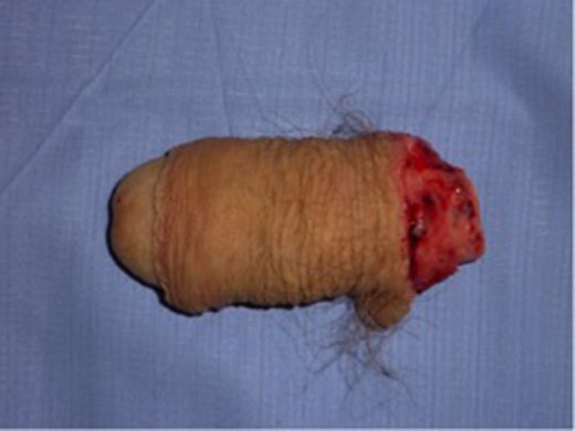 Distal amputated penis.