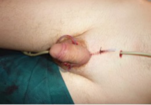 Reattachment of penis with suprapubic and urethral catheters in situ along with wound drains.