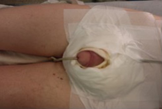 Post-operative wound dressings.