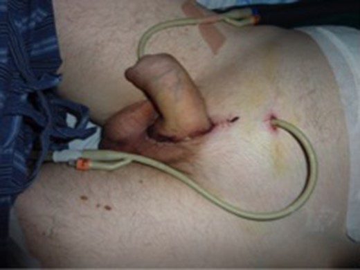 Continued wound healing following removal of drains.