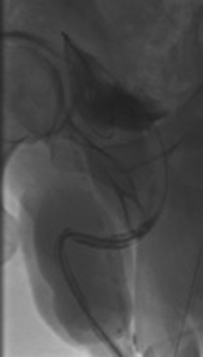 Post-operative peri-catheter urethrogram.