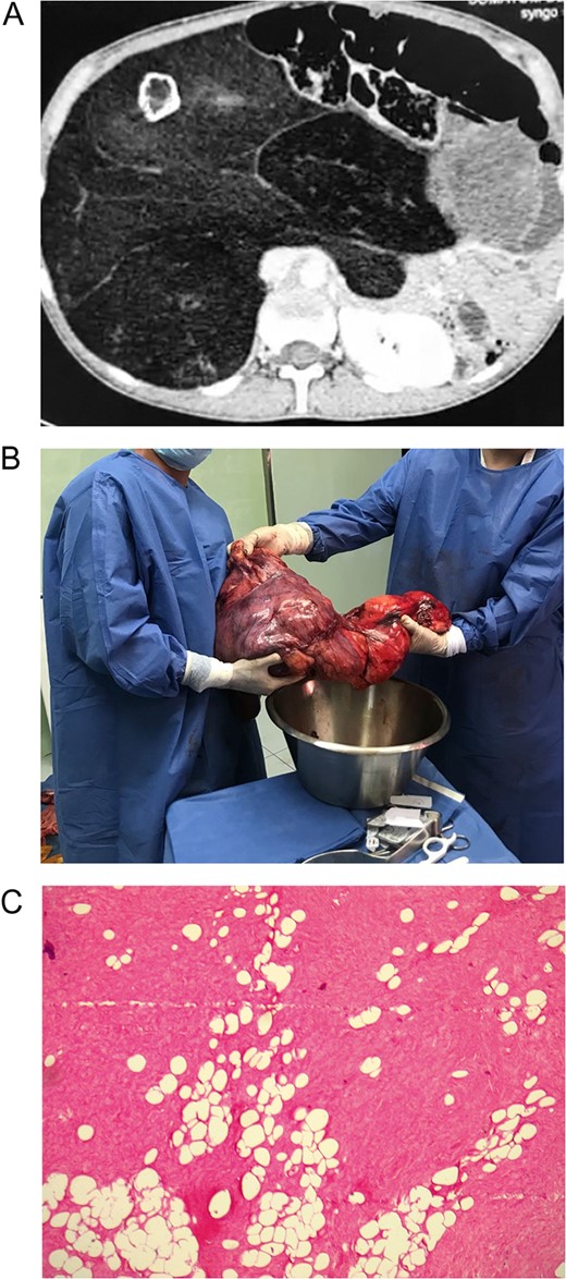 (A) Abdominal CT revealed a huge encapsulated retroperitoneal tumor with a soft tissue density, and an area containing a calcification. (B) Massive retroperitoneal dedifferentiated liposarcoma. (C) Mature adipocytes with some enlarged atypical nuclei.