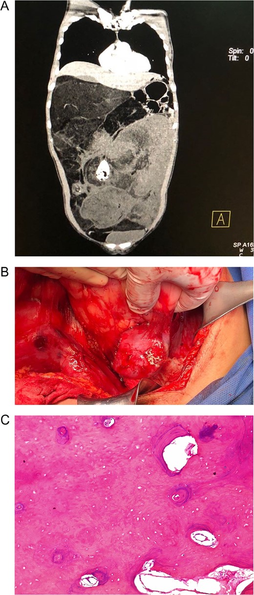 (A) Abdominal CT: Retroperitoneal tumor that displaced the liver, right kidney and most of the bowel. (B) Giant retroperitoneal mass, the mass had multiple adhesion to adjacent organs making dissection troublesome. (C) Transition towards a fusiform cell sarcoma and areas of benign ossification.
