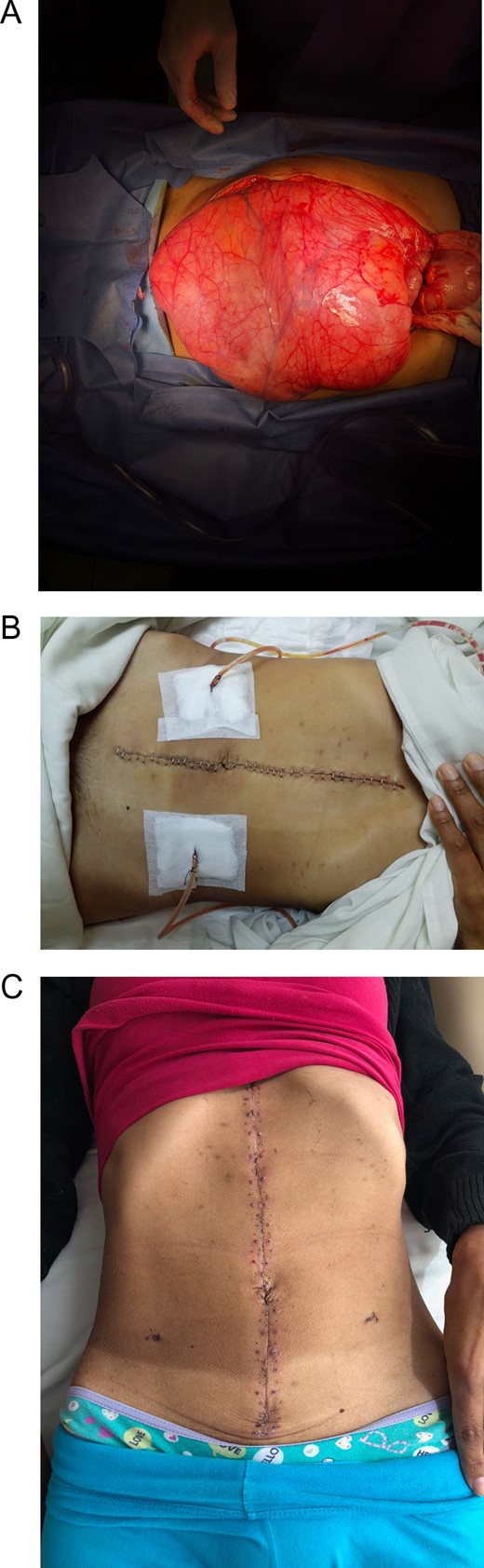 (A) Giant reddish soft consistency retroperitoneal mass. (B) Abdomen, after successful surgery, the mass was resected and the drains were left in place. (C) Patient on follow-up controls.