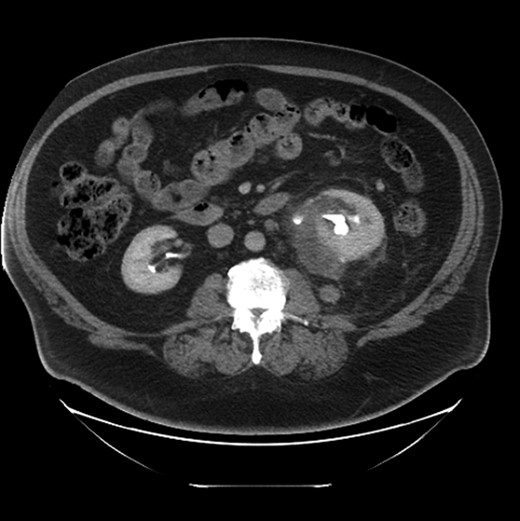 CT scan demonstrates a fluid collection posterior and inferior to the left kidney extensive infiltrative changes extending inferiorly into the pelvis. There is a 2 cm nodule posterior to the kidney, which was biopsied, and two enlarged para-aortic nodes (not seen on this image).