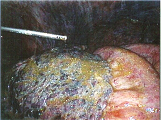Intraoperative image taken during diagnostic laparoscopy that revealed purplish discoloration and thickening of the omentum with inflammatory reaction on the parietal peritoneum.