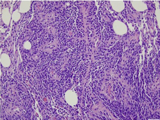 Histopathological analysis of formalin-fixed tissue sections of omentum showed diffuse involvement by a spindle cell neoplasm demonstrating both formation of vascular channels and solid areas of growth. Immunohistochemical stains (not shown here) were positive for CD31 and CD34. They were negative for cKit, DOG1, and keratins AE1/3 and cam5.2.