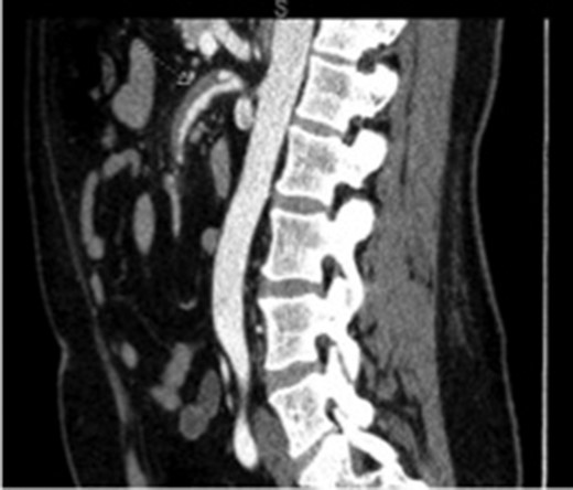 Initial imaging showing a thrombosed dissection, originating 2 cm from the ostium of the SMA with extension into the second and third order branches.