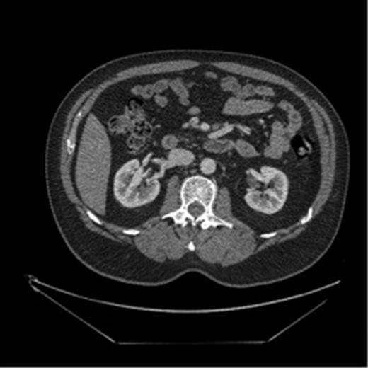 Selective jejunal thrombosis on repeat imaging.