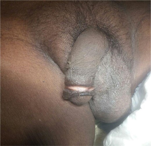 Preoperative: a ring shaped skin erosion was present near the corona glandis with exposed under lying superficial fascia of penis.