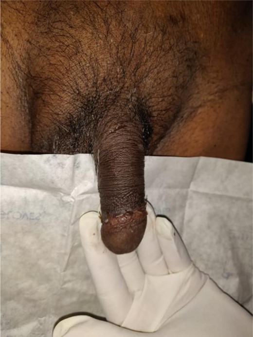 Postoperative: circumscribed penile skin with healthy wound.