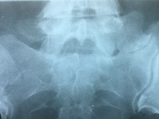 Radiographs showing an overdeveloped left transverse process, which contacts with the sacrum left sacral wing (Castelvi’s Type IIa).