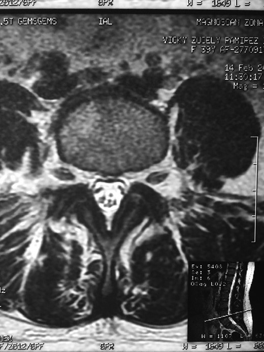 RMN of the patient showing smaller facets in the anomalous articulation and healthy disc compared to the supradjacent one (next figure).