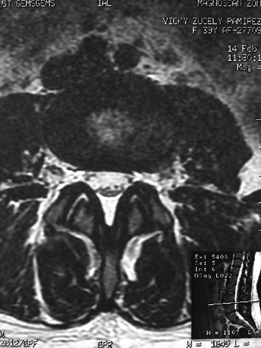 Degenerative changes at the facets and disc in the adjacent segment.