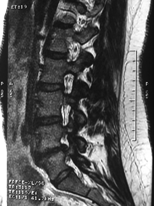 Showing the protective effect of the limitation of the motion in the distal disc to the anomaly.
