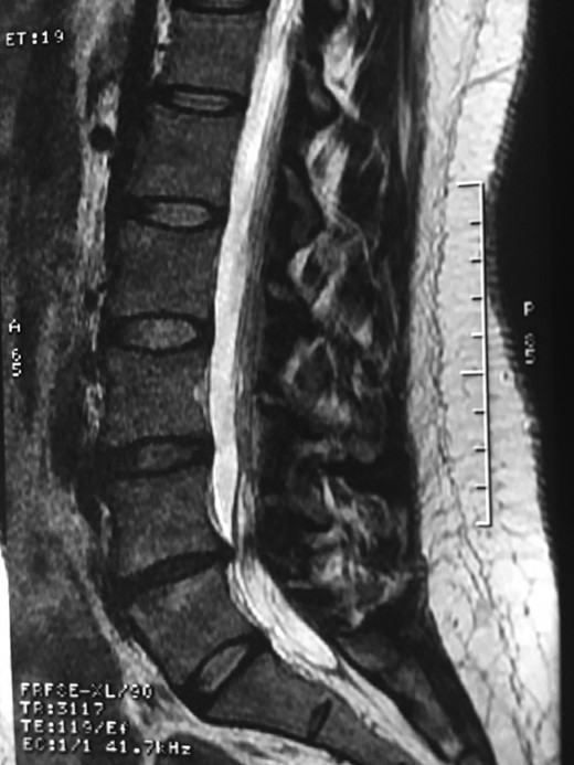 Showing the protective effect of the limitation of the motion in the distal disc to the anomaly.