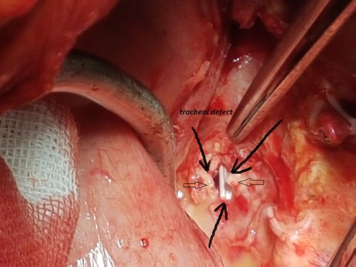 Intra-operative image showing posterior wall defect (open arrows).