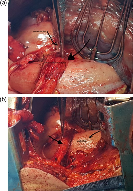 (a and b) Intercostal muscle flap (open arrow) and pericardial flap (star).