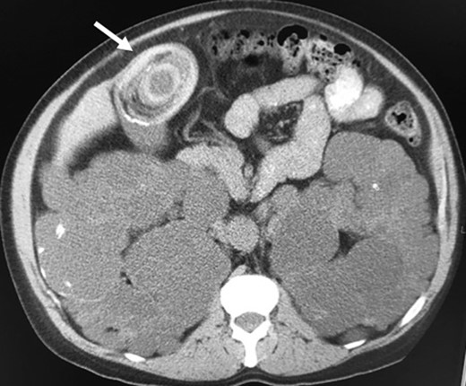 Giant gallstone located in the gallbladder on abdominopelvic CT scan.