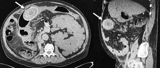 Giant gallstone located in the proximal transverse colon on abdominopelvic CT scan.