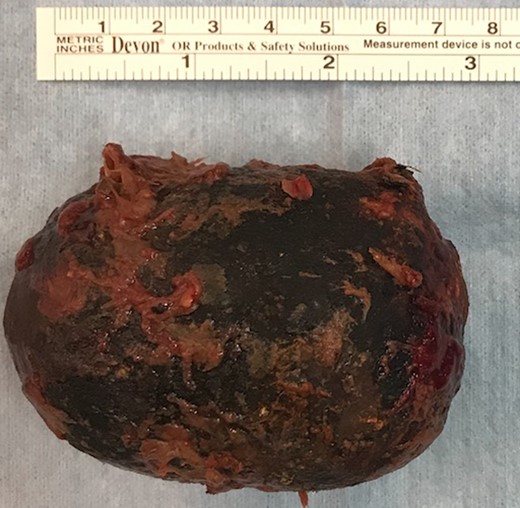 Giant gallstone retrieved from the transverse colon.