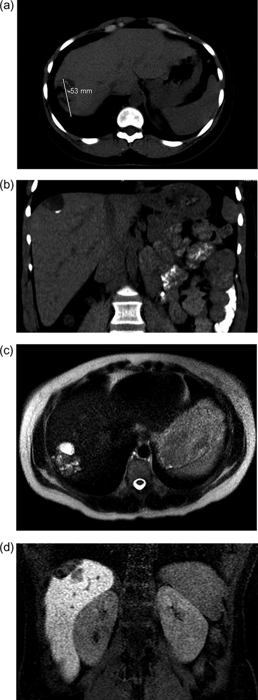 (a and b) CT abdomen and pelvis without IV contrast demonstrating tumor in axial (a) and coronal views (b). (c and b). MR abdomen and pelvis with and without IV contrast (Eovist, gadoxetate disodium, Bayer Pharmaceuticals) showing 3.7 × 5 × 2 cm3 complex lesion containing cystic elements, macroscopic fat and calcification in axial (c) and coronal (d) views.