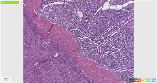 Liver parenchyma abutting neuroendocrine tumor.