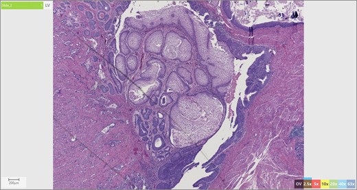 Skin adnexae and glandular elements of the mature cystic teratoma.