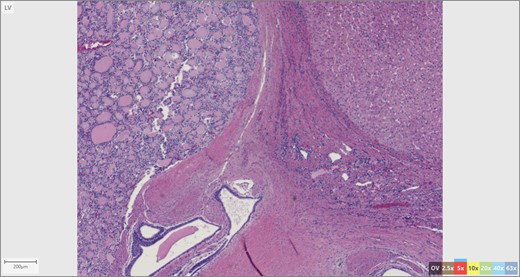Thyroid tissue (left) adjacent to liver parenchyma.