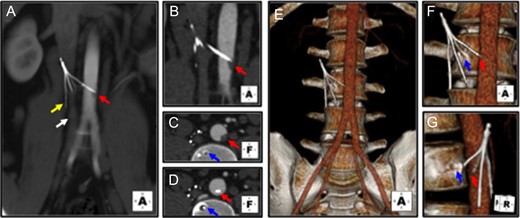Preoperative CTA demonstrates Gunther Tulip IVC filter perforation of the infrarenal aorta, lumbar spine and psoas muscle. (A) IVC filter in occluded atretic appearing infrarenal IVC (white arrow). IVC filter legs are protruding out of the IVC wall, embedding into the adjacent right psoas muscle (yellow arrow), and adjacent infrarenal aorta (red arrow). (B) Coronal view demonstrates partial obstruction of the aortic lumen at the tip of the perforating IVC filter leg (red arrow). (C and D) Transverse cross-sectional views demonstrates protrusion of filter leg in aorta and partial obstruction of aortic lumen (red arrows), as well as embedding of one of the filter legs into the L3 vertebral body (blue arrows). (E–G) Three dimensional reconstructions also demonstrate protrusion of the IVC filter legs into the aorta (red arrows), and lumbar spine (blue arrows).