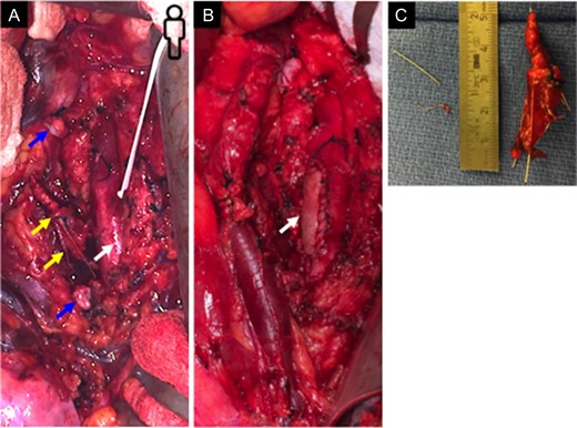 Open operative IVC filter explantation and aortic repair. (A) Transabdominal exposure of the infrarenal aorta (white arrow). The chronically occluded infrarenal IVC was segmentally ligated and transected (ligated ends indicated by blue arrows). Tilted IVC filter is visualized adjacent and attached to the infrarenal aorta (yellow arrows). (B) Successful explantation of IVC filter and repair of infrarenal aorta with a bovine pericardial patch. (C) Explanted IVC filter body with associated dense fibrous tissue, as well as leg fragments removed from the infrarenal aortic lumen.