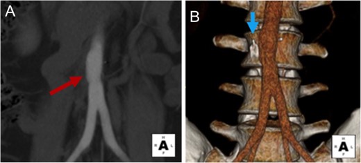 Postoperative CTA demonstrates stable aortic repair. (A) Coronal views demonstrate patent infrarenal aorta and patch angioplasty repair site. (B) 3D reconstruction demonstrates normal caliber infrarenal aorta, and residual IVC filter leg embedded in the L3 vertebral body.