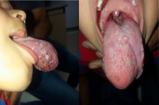 Appearance of the lingual cavernous hemangioma on clinical examination.