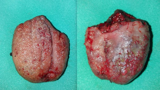 The dorsal and ventral appearance of the lingual hemangioma immediately after excision.