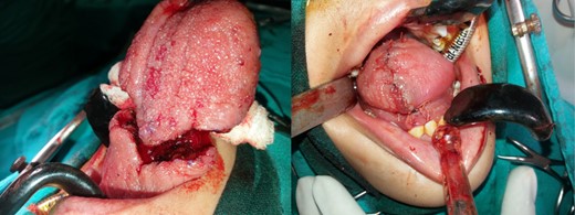 On table appearance of the specimen nearing excision and after reconstruction of the residual tongue.