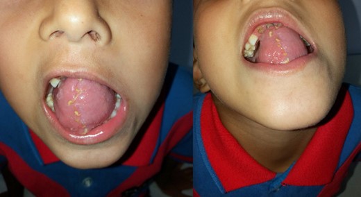 Dorsal and ventral appearance of the reconstructed residual tongue at outpatient follow up after 10 days.