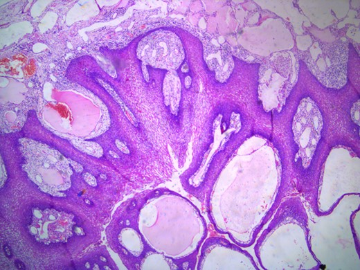 Microscopic appearance of the lingual cavernous hemangioma stained with eosin and hematoxylin at four times magnification.