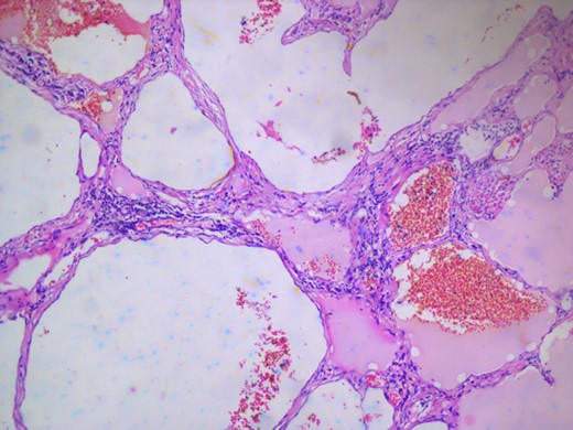 Microscopic appearance of the lingual cavernous hemangioma stained with eosin and hematoxylin at 10 times magnification.