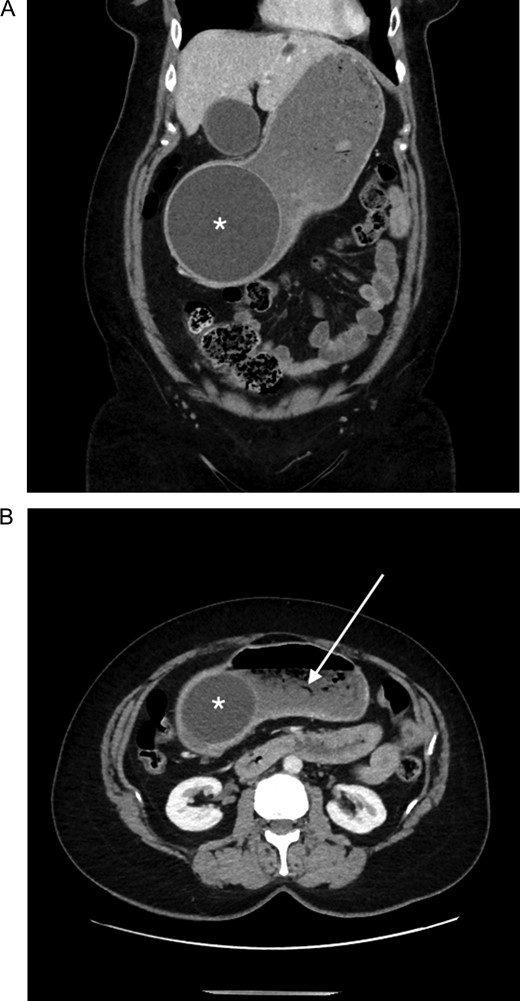 Abdominal computed tomography showing (A) an intragastric balloon within the gastric antrum (asterisk), with (B) a moderately distended fluid and gas filled gastric fundus and body (arrow).