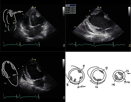 Left ventricular apical thrombus on echocardiography.