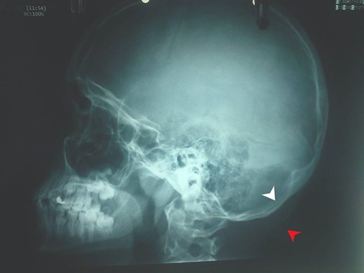 Head profile X-ray. Bone thinning (white arrow) caused by the mass (red arrow).