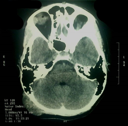 Axial head CT, brain window.