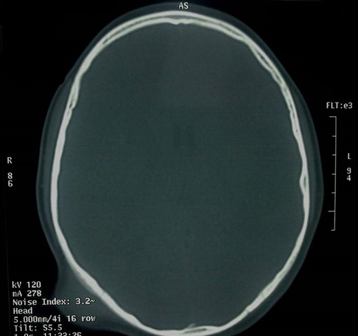 Axial head CT, bone window.