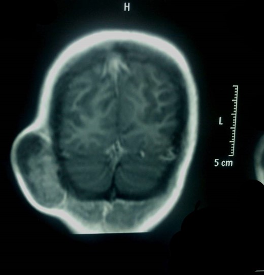 Brain MRI, coronal view.